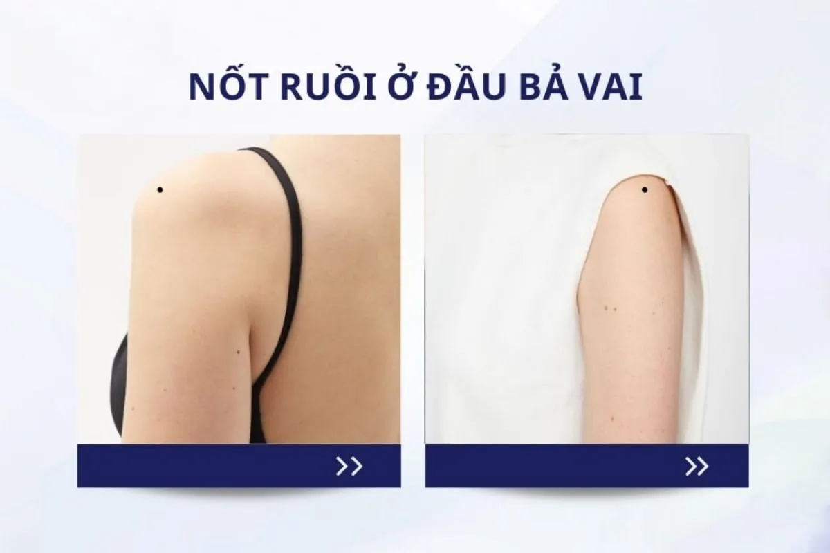 Ý nghĩa nốt ruồi ở vai trái nữ – Tốt hay xấu, hung hay cát